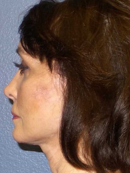 Facelift Before & After Patient #11672