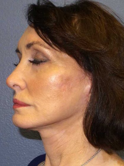 Facelift Before & After Patient #11672