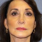 Facelift Before & After Patient #11672