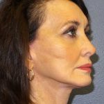 Facelift Before & After Patient #11672