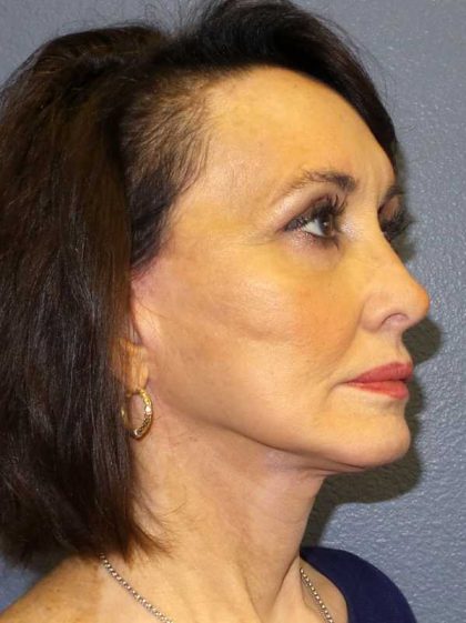 Facelift Before & After Patient #11672