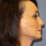 Facelift Before & After Patient #11672
