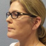 Facelift Before & After Patient #7572