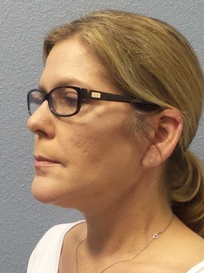 Facelift Before & After Patient #7572