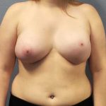 Asymmetric (Uneven) Breasts Before & After Patient #11167
