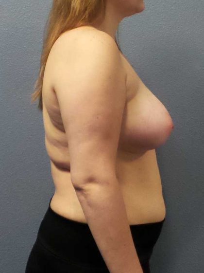 Asymmetric (Uneven) Breasts Before & After Patient #11167