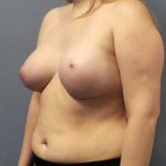 Asymmetric (Uneven) Breasts Before & After Patient #11167