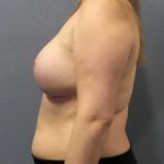 Asymmetric (Uneven) Breasts Before & After Patient #11167
