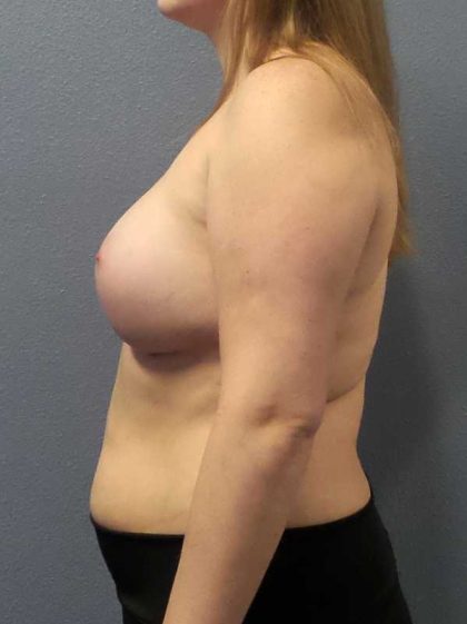 Asymmetric (Uneven) Breasts Before & After Patient #11167
