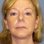 Facelift Before & After Patient #11876