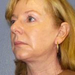 Facelift Before & After Patient #11876