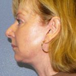 Facelift Before & After Patient #11876