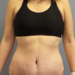 Abdominoplasty Before & After Patient #11097