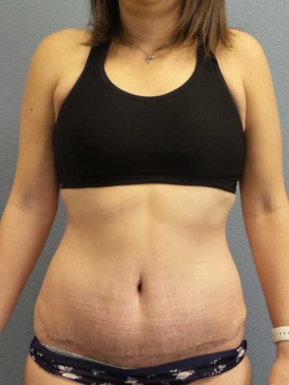 Abdominoplasty Before & After Patient #11097