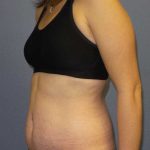 Abdominoplasty Before & After Patient #11097