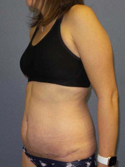 Abdominoplasty Before & After Patient #11097