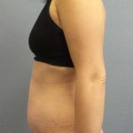 Abdominoplasty Before & After Patient #11097
