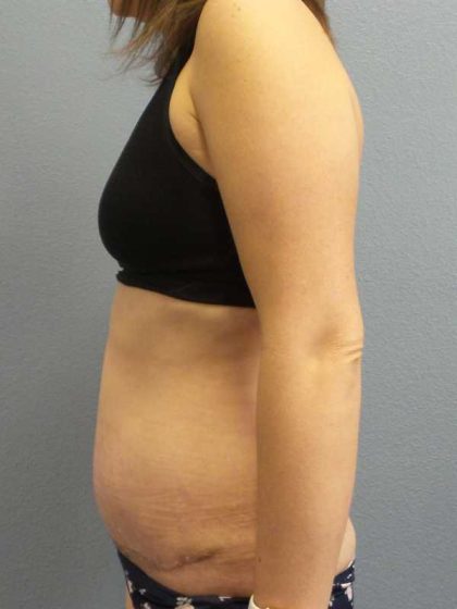Abdominoplasty Before & After Patient #11097