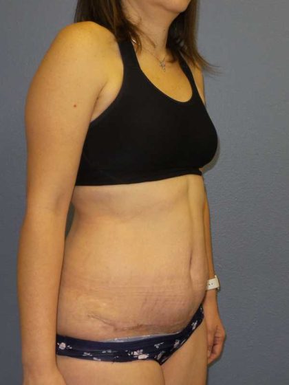 Abdominoplasty Before & After Patient #11097