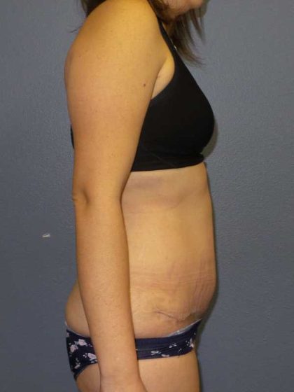 Abdominoplasty Before & After Patient #11097