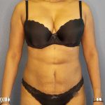 Liposuction Female Before & After Patient #11994
