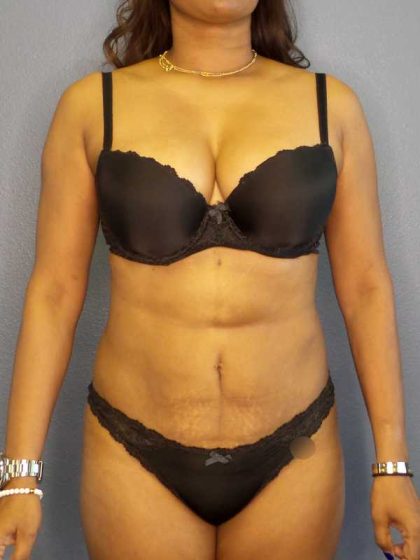 Liposuction Female Before & After Patient #11994