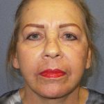 Facelift Before & After Patient #7570