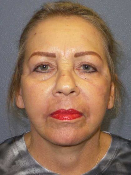 Facelift Before & After Patient #7570