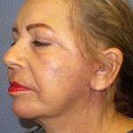 Facelift Before & After Patient #7570