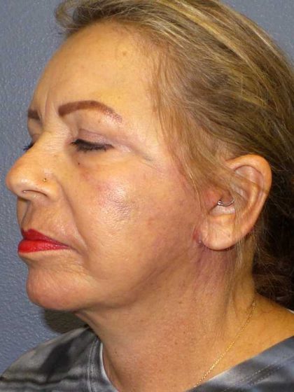 Facelift Before & After Patient #7570