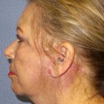 Facelift Before & After Patient #7570