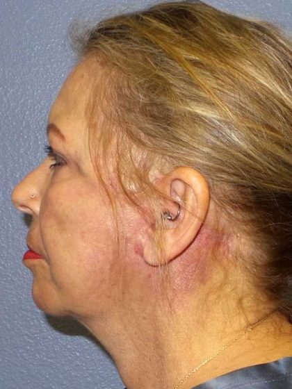 Facelift Before & After Patient #7570