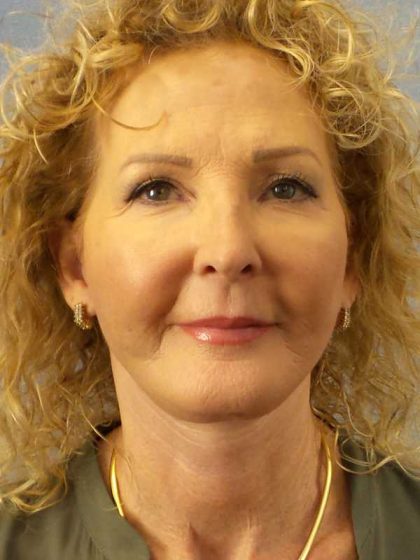 Facelift Before & After Patient #11756