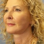 Facelift Before & After Patient #11756