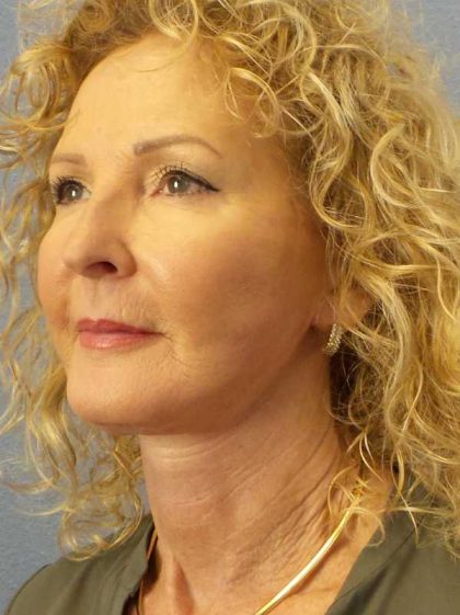 Facelift Before & After Patient #11756