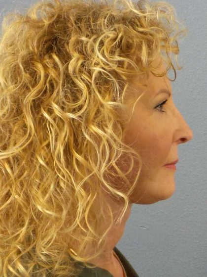 Facelift Before & After Patient #11756