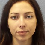 Rhinoplasty Before & After Patient #12362