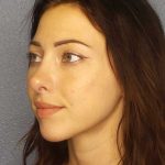 Rhinoplasty Before & After Patient #12362