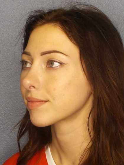Rhinoplasty Before & After Patient #12362