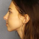 Rhinoplasty Before & After Patient #12362