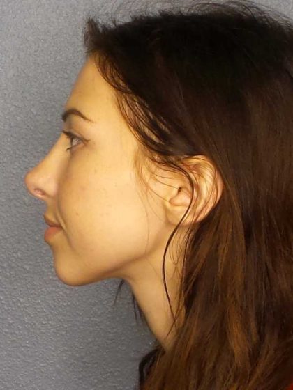 Rhinoplasty Before & After Patient #12362