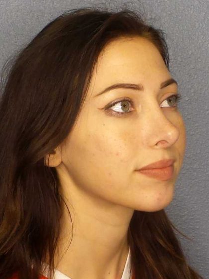 Rhinoplasty Before & After Patient #12362