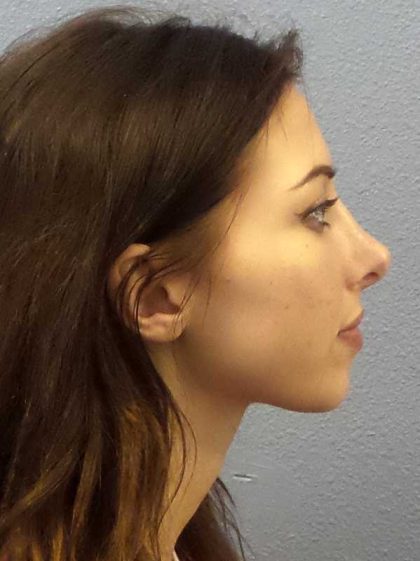 Rhinoplasty Before & After Patient #12362