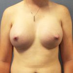 Breast Augmentation Before & After Patient #11367