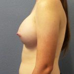 Breast Augmentation Before & After Patient #11367