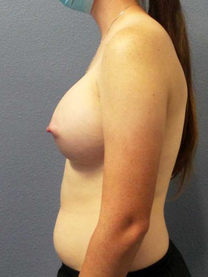Breast Augmentation Before & After Patient #11367