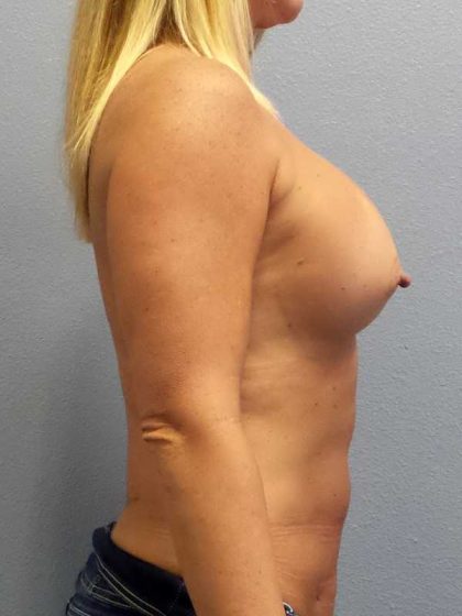 Breast Augmentation Before & After Patient #11459
