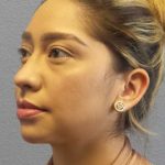 Liposuction of the Neck Before & After Patient #12082