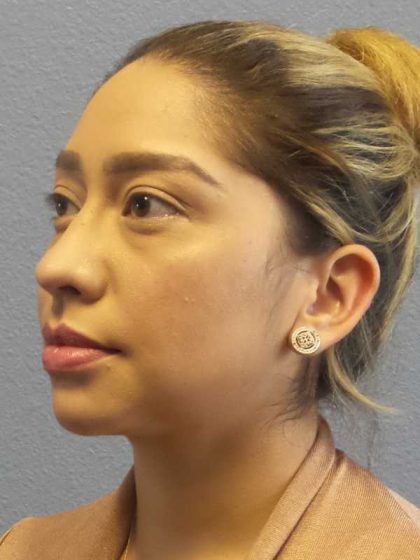 Liposuction of the Neck Before & After Patient #12082
