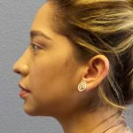 Liposuction of the Neck Before & After Patient #12082